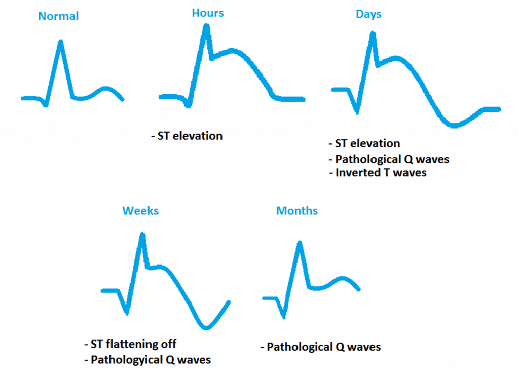 ECG changes in STEMI